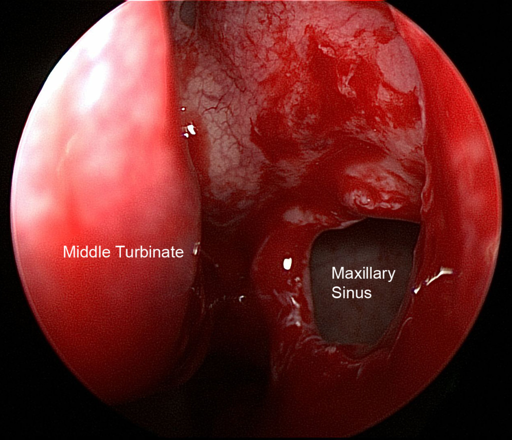 Image of left maxillary sinus opening after the opening has been enlarged