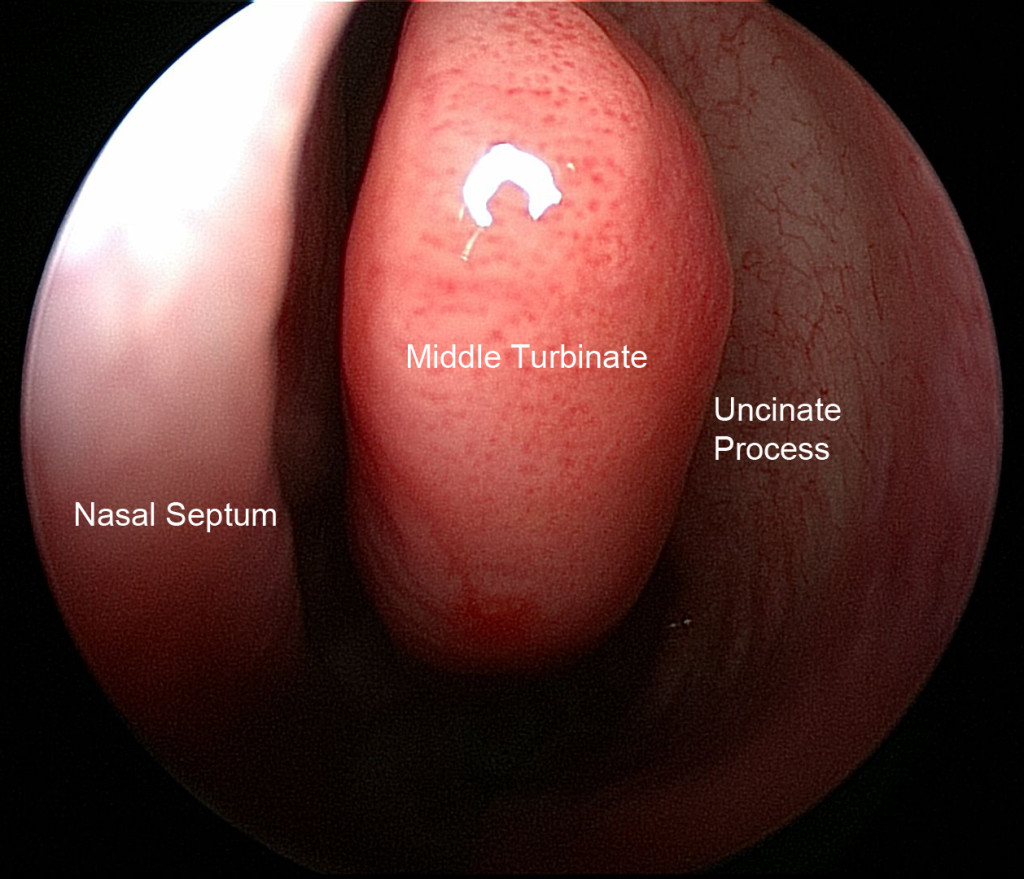 Image of the area where the left maxillary sinus drains