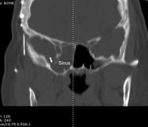 CSF Leak Repair - Facial Plastic, Nasal, & Sinus Surgery - Drs. Goyal