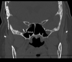 CSF Leak Repair - Facial Plastic, Nasal, & Sinus Surgery - Drs. Goyal